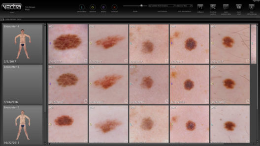 Software que se usa para monitorear el crecimiento de los lunares y lesiones en la piel. Cortesia de Canfield Scientific.